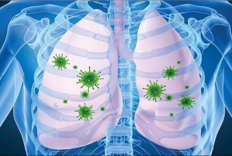 ذات الریه چیست؟ | علائم، علل و روش های درمانی برای پیشگیری و بهبودی سریع 7 ذات الریه چیست؟ | علائم، علل و روش های درمانی برای پیشگیری و بهبودی سریع