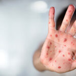 همه چیز درباره شایعه سرخک و سرخجه در کشور اقدامات واکسیناسیون و نظام سلامت