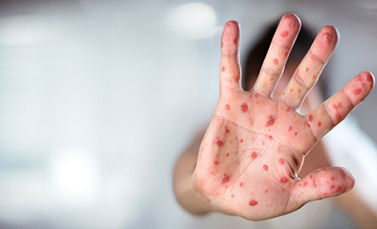 همه چیز درباره شایعه سرخک و سرخجه در کشور اقدامات واکسیناسیون و نظام سلامت 28 همه چیز درباره شایعه سرخک و سرخجه در کشور اقدامات واکسیناسیون و نظام سلامت