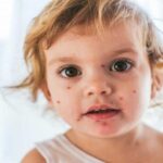 افزایش موارد سرخک در کشور