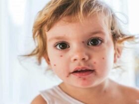 افزایش موارد سرخک در کشور