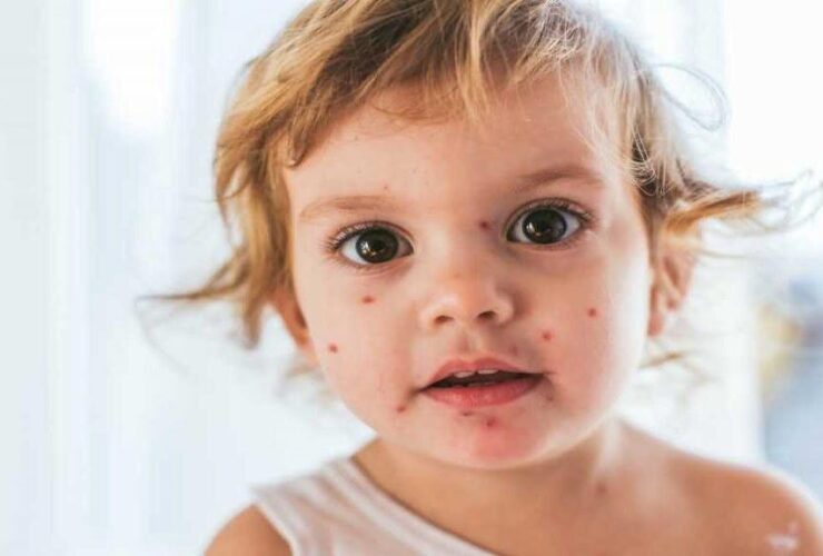 افزایش موارد سرخک در کشور 17 افزایش موارد سرخک در کشور