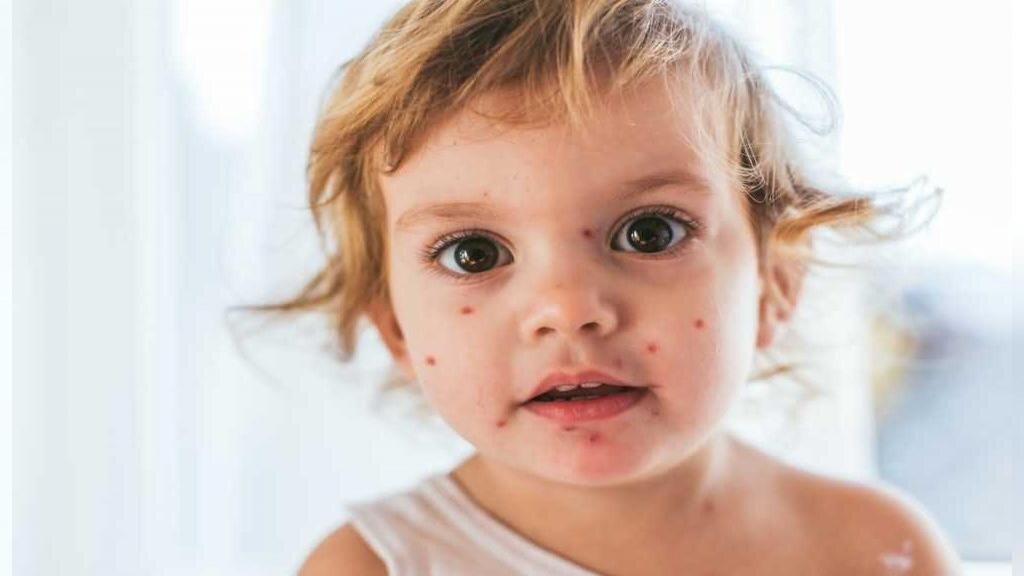 افزایش موارد سرخک در کشور 1 افزایش موارد سرخک در کشور