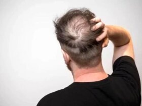 4 پیشنهاد مهم برای کسانی که ریزش مو دارند 9 4 پیشنهاد مهم برای کسانی که ریزش مو دارند