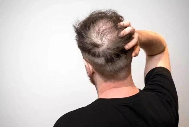 4 پیشنهاد مهم برای کسانی که ریزش مو دارند