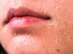 5 روش برای مراقبت از پوست در زمستان