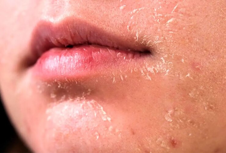 5 روش برای مراقبت از پوست در زمستان