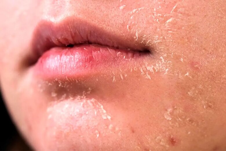 5 روش برای مراقبت از پوست در زمستان