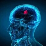 قطره های بینی که تومورهای کشنده مغز را کوچک می کند