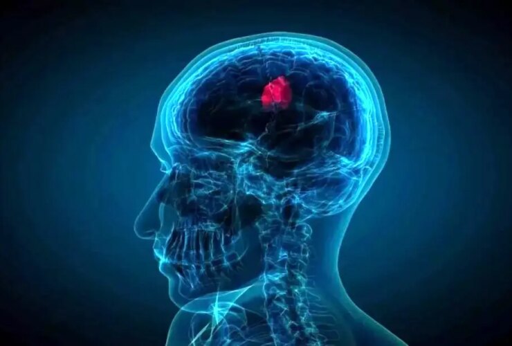 قطره های بینی که تومورهای کشنده مغز را کوچک می کند