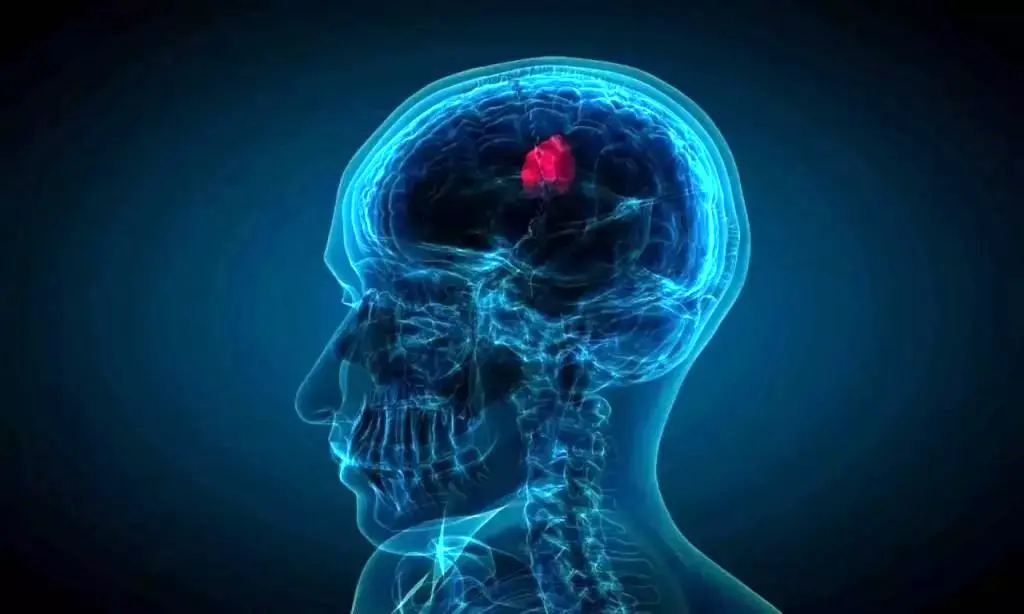 قطره های بینی که تومورهای کشنده مغز را کوچک می کند 1 قطره های بینی که تومورهای کشنده مغز را کوچک می کند