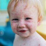 هیچ درمان ضد ویروسی برای سرخک وجود ندارد