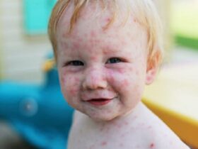 هیچ درمان ضد ویروسی برای سرخک وجود ندارد 10 هیچ درمان ضد ویروسی برای سرخک وجود ندارد