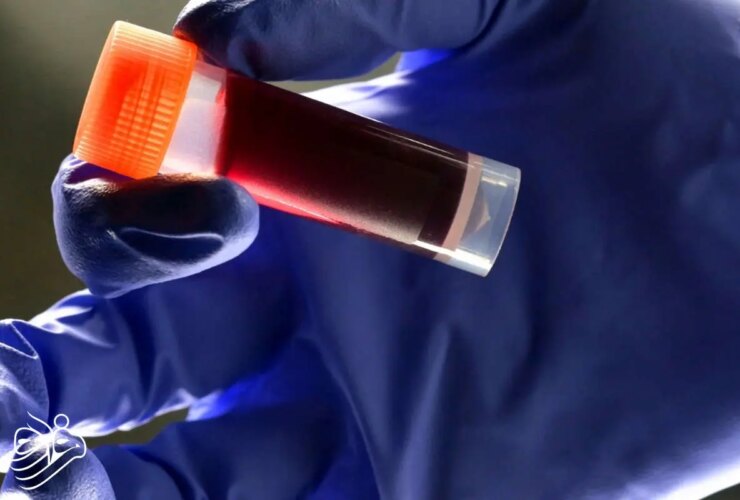 گروه خونی که بیشترین سکته های مغزی را ایجاد می کند!