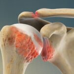 بیماران در مورد انجام جراحی تعویض مفصل زانو نگران هستند. آیا این جراحی برای بیماران دیابتی خطرناک است؟