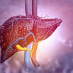 علائم کبد چرب چیست؟