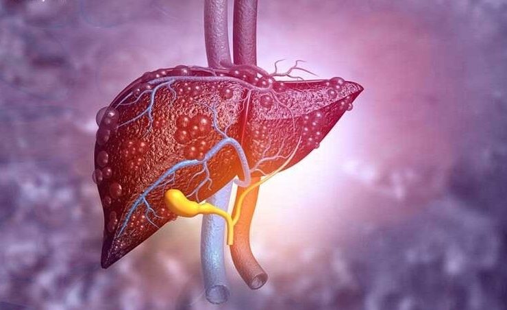 علائم کبد چرب چیست؟ 18 علائم کبد چرب چیست؟