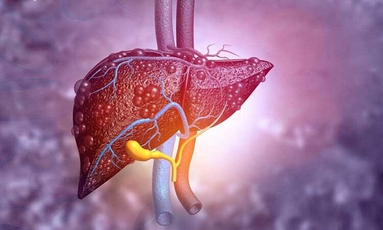 علائم کبد چرب چیست؟