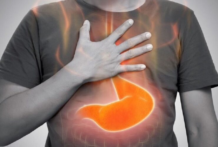 رفلاکس معده چیست و چگونه درمان می شود؟ | کدام غذاها باعث رفلاکس معده می شوند؟ 30 رفلاکس معده چیست و چگونه درمان می شود؟ | کدام غذاها باعث رفلاکس معده می شوند؟