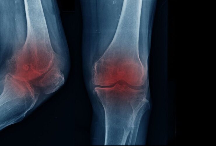 آیا پیاده روی و ورزش باعث آرتروز زانو می شود؟ / علائم آرتروز زانو چیست؟