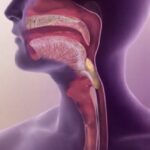 درمان اختلال بلع چیست؟