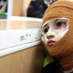 میزان سوختگی در ایران 8 برابر میانگین جهانی است/3000 نفر جان خود را از دست می دهند