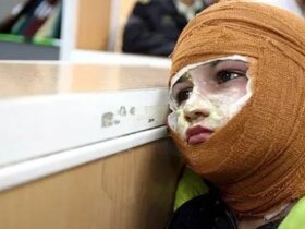 میزان سوختگی در ایران 8 برابر میانگین جهانی است/3000 نفر جان خود را از دست می دهند 8 میزان سوختگی در ایران 8 برابر میانگین جهانی است/3000 نفر جان خود را از دست می دهند