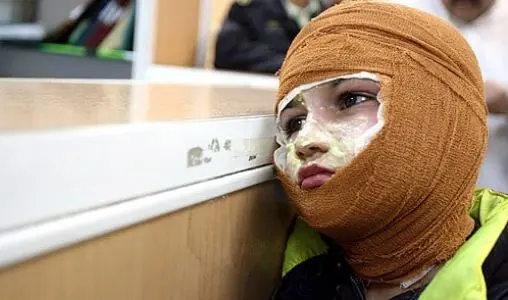 میزان سوختگی در ایران 8 برابر میانگین جهانی است/3000 نفر جان خود را از دست می دهند