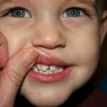 علل پوسیدگی دندان در کودکان چیست/چگونه از این عارضه پیشگیری کنیم؟