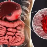 این داروها دومین علت شایع زخم معده هستند