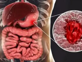 این داروها دومین علت شایع زخم معده هستند 8 این داروها دومین علت شایع زخم معده هستند