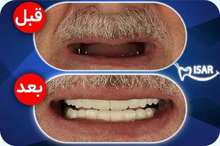 ایمپلنت، ارتودنسی و کامپوزیت دندان