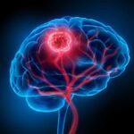 آیا تومور مغزی در کودکان قابل درمان است؟