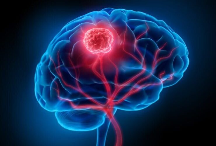 آیا تومور مغزی در کودکان قابل درمان است؟