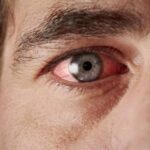 سیاهی چشم چیست و چه علائمی دارد؟ / فشار چشم ربطی به فشار خون سیستمیک ندارد