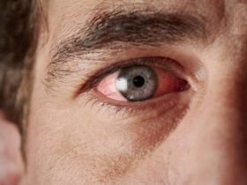 سیاهی چشم چیست و چه علائمی دارد؟ / فشار چشم ربطی به فشار خون سیستمیک ندارد 8 سیاهی چشم چیست و چه علائمی دارد؟ / فشار چشم ربطی به فشار خون سیستمیک ندارد