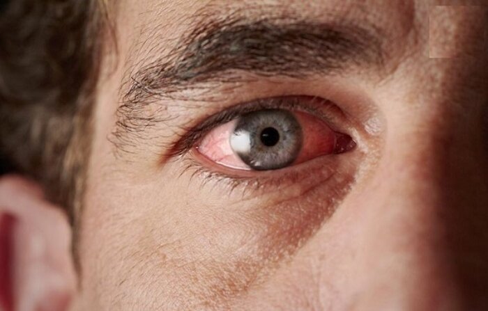 سیاهی چشم چیست و چه علائمی دارد؟ / فشار چشم ربطی به فشار خون سیستمیک ندارد 1 سیاهی چشم چیست و چه علائمی دارد؟ / فشار چشم ربطی به فشار خون سیستمیک ندارد