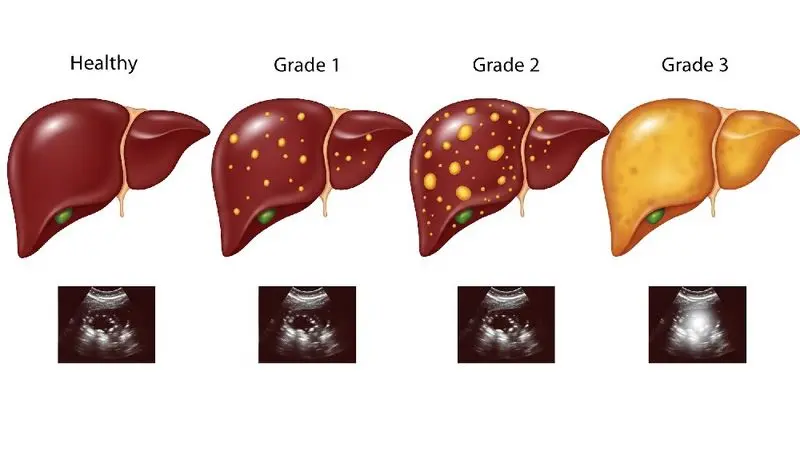 آیا آزمایش خون درجه کبد چرب را مشخص می کند؟ 4 کبد چرب