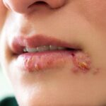 تفاوت بین برفک دهان و تبخال چیست؟