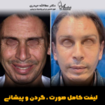 عمل لیفت صورت در مردان و زنان | مقایسه و بررسی تفاوت ها