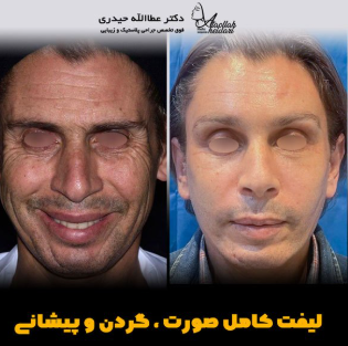 عمل لیفت صورت در مردان و زنان | مقایسه و بررسی تفاوت ها