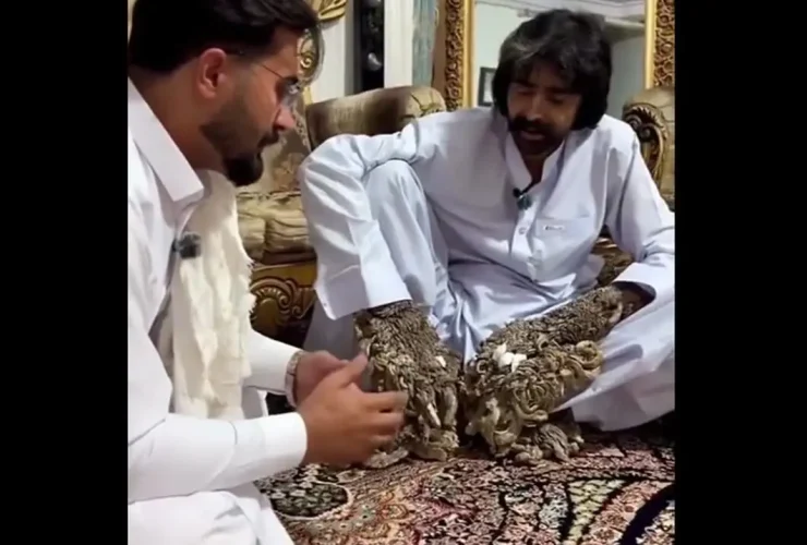مرد درختی برای معالجه به آمریکا رفت